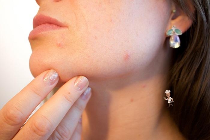 Foods to keep off Pimples and Acne
