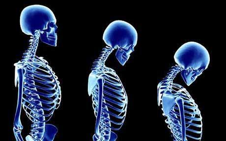 Osteoporosis - Causes, symptoms, Diagnosis and Treatment.