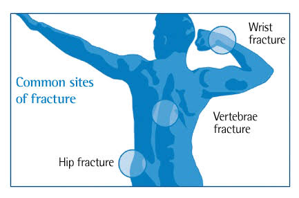 Osteoporosis - Causes, symptoms, Diagnosis and Treatment.