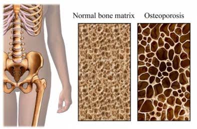 Osteoporosis - Causes, symptoms, Diagnosis and Treatment.