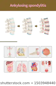 effects of spondylitis